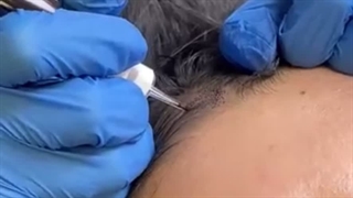 بهترین کلینیک کاشت مو در تهران