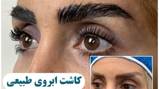 کاشت ابرو بعد از یکسال