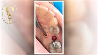 ایمپلنت یک دندان بدون جراحی و بخیه