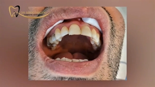 کامپوزیت دندان های جلو | دکتر سعید میرزایی