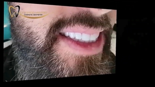۲۰ واحد کامپوزیت ونیر | دکتر سعید میرزایی متخصص دندانپزشکی زیبایی