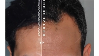 داشتن یک خــــــــــــــــط رویش طبیعی دیگر آرزو نیست