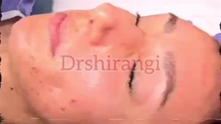 فیلم واقعی جراحی بینی دکتر سعید شیرنگی