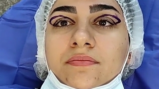 بلفاروپلاستی و درمان افتادگی پلک توسط فوق تخصص پلک