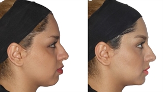 ارتودنسی و کشیدن دندان | دکتر داودیان