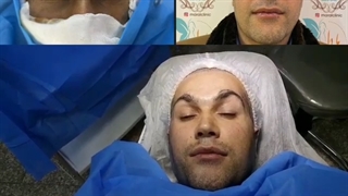 کاشت مو لیفت دایرکت ابرو برای آقایان-کلینیک vip تهران