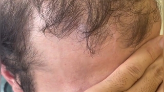 کاشت ناموفق