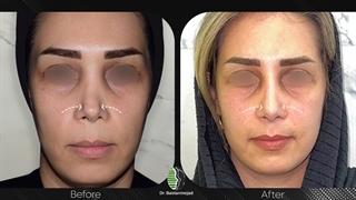 جراحی زیبایی بینی ترمیمی | دکتر باستانی نژاد