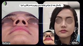 جراحی بینی پهن و گوشتی
