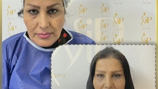 مشاوره تزریق چربی به بدن و صورت-کلینیک vip تهران جوانسازی پوست