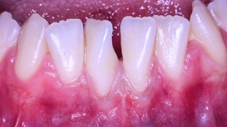 جراحی لثه با لیزر | درمان تحلیل رفتن لثه با پیوند بافت نرم