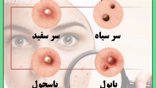 انواع جوش صورت و راهکارهای معجزه آسا برای درمان آن