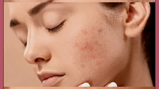 جوش پریودی چیست؟ علل ایجاد، انواع و نحوه درمان آن ها