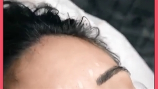 علت سردرد بعد از بوتاکس چیست؟