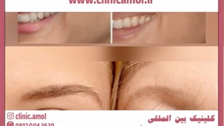 راهکارهای درمان چین و چروک دور چشم (خطوط پنجه کلاغی)
