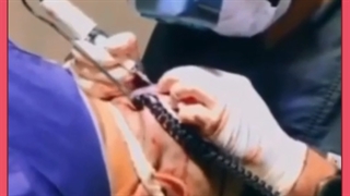 بهترین داروهای بعد از کاشت مو – آپدیت ۲۰۲۲