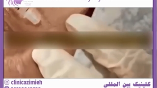 راهکارهای درمان چین و چروک دور چشم (خطوط پنجه کلاغی) لیزر فرکشنال