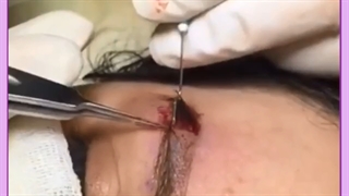 عوامل موثر در ماندگاری کاشت ابرو را بشناسید