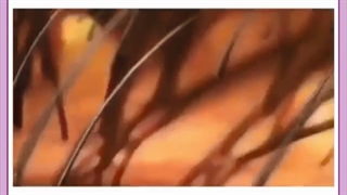 درمان ریزش موی ژنتیکی یا ارثی مردان و انواع الگوی طاسی مردانه