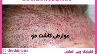 عفونت بعد از کاشت مو | علائم ، نحوه درمان با تصویر