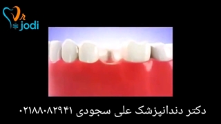 ایمپلنت فوری در کلینیک دکتر علی سجودی