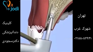 ایمپلنت دندان در تهران