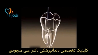 قیمت عصب کشی دندان