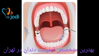 متخصص ایمپلنت دندان در تهران