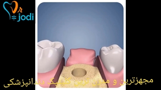 فیلم ایمپلنت دندان
