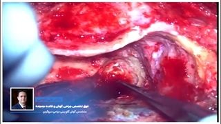 جراحی آکوستیک نوروما یا شوانوم وستیبولار با اپروچ ترانس لابیرنتین