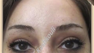 لیفت اندوسکوپی شقیقه، پیشانی ، ابرو و کانتوس خارجی راست> چپ (چشم گربه ای)