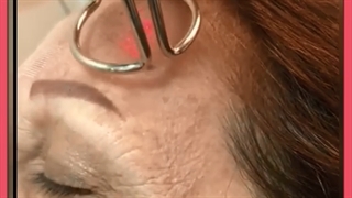 جوانسازی پوست با لیزر و هایفو لیپوماتیک