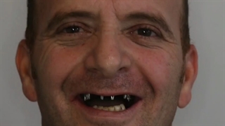 ایمپلنت فوری