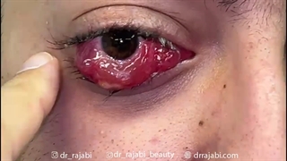 جراحی تومور بزرگ چشم
