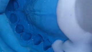 ادامه قالبگیری دندانها