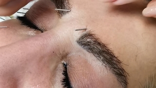 جوانسازی صورت با طب سوزنی بدون درد و عوارض پاکسازی پوست