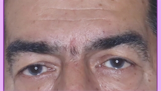 رفع پف چشم
