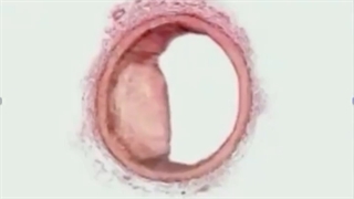 از اترواسکلروز تا یک سکته قلبی!