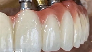 روکش های تمام سرامیکی زیرکونیا متکی بر ایمپلنت | دکتر محمد محمدی
