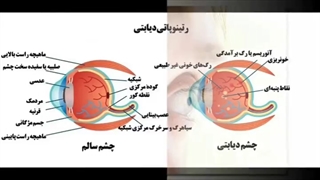 خونریزی چشم