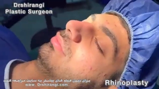 تجربه جراحی بینی مردانه در مطب دکتر شیرنگی