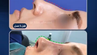 بلافاصله بعد از جراحی زیبایی بینی