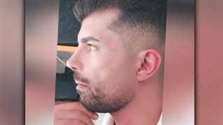 دو سال بعد از عمل بینی