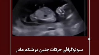 سونوگرافی حرکات جنین
