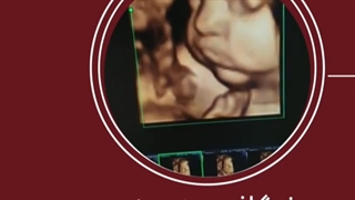 سونوگرافی سه بعدی پسر تپلی