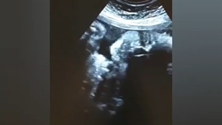 تصویر سه بعدی صورت جنین ۳۱ هفته پسر