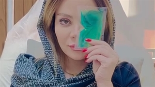 مراقبت های بعد از عمل بلفاروپلاستی