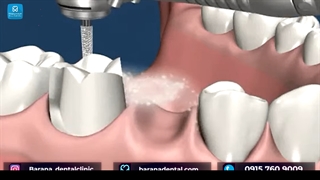 زمانی که یک دندان کشیده می شود، بریج چگونه به کمک دهان می آید؟