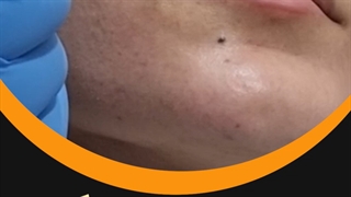 مزونیدیلینگ