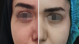 لیفت اندوسکوپیک ابرو و عمل بینی-بهترین جراح بینی در تهران